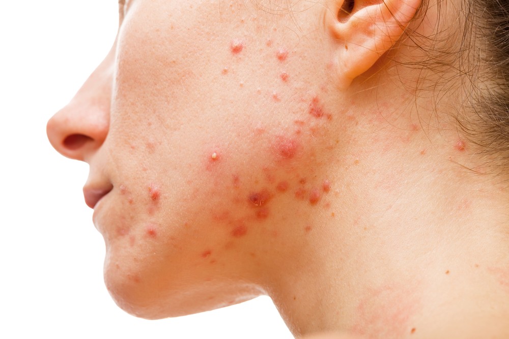 The gut-skin connection and what to do about it