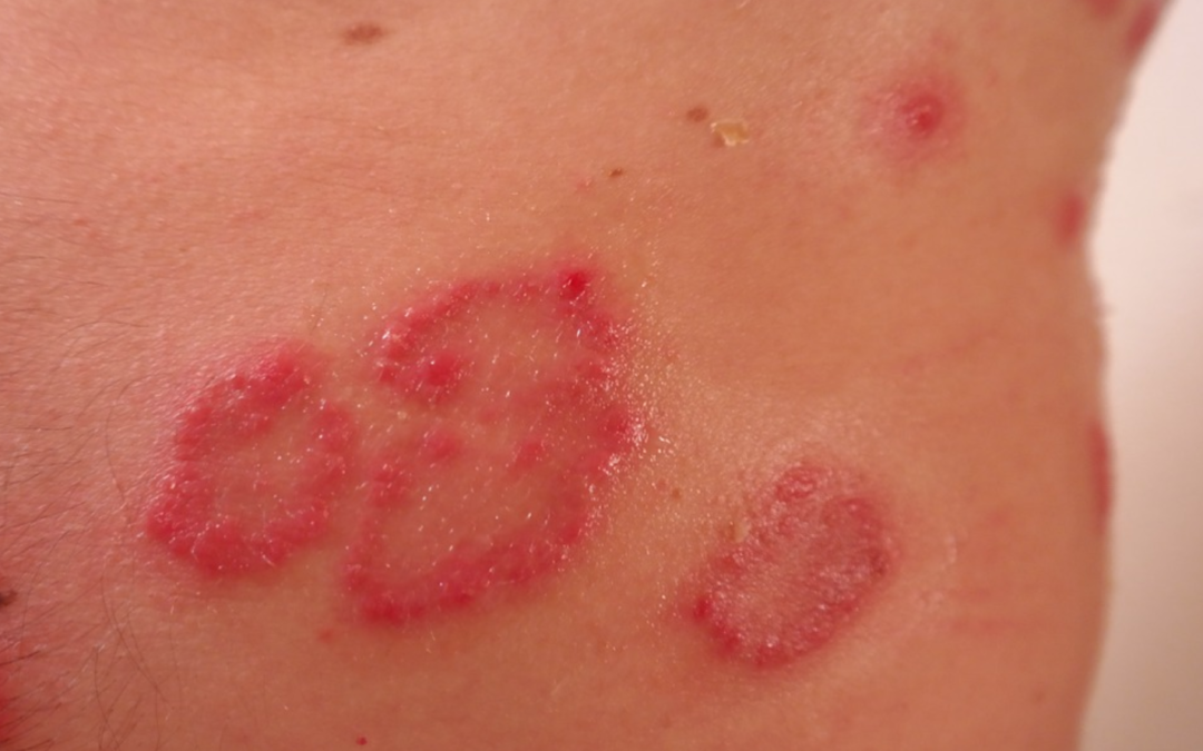 Histamine intolerance is a big deal. Here’s why (and why you may well have it and not know it).